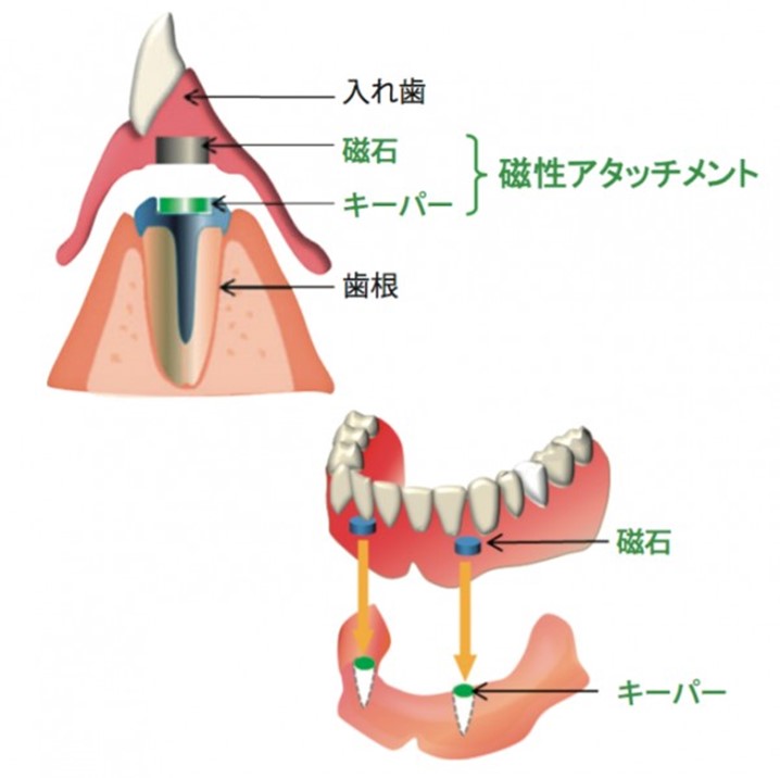 磁石式入れ歯