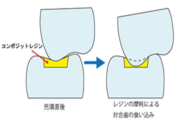 対合歯