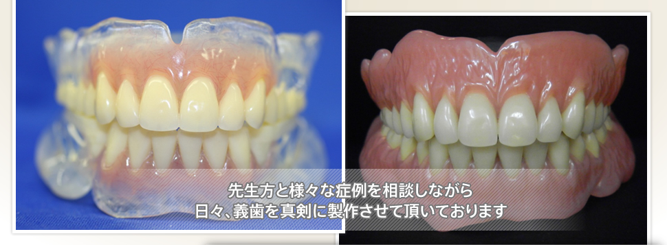自費義歯専門歯科技工士によるレジン床義歯